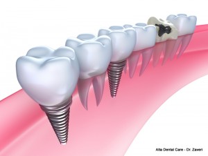 dental implants