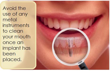 dental implants