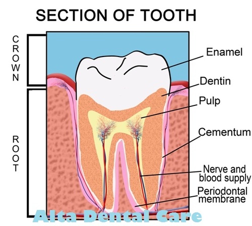 dealing with cracked tooth