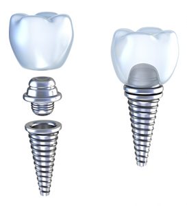 2 dental implants