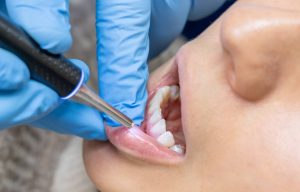 featured image for do whitening treatments damage teeth