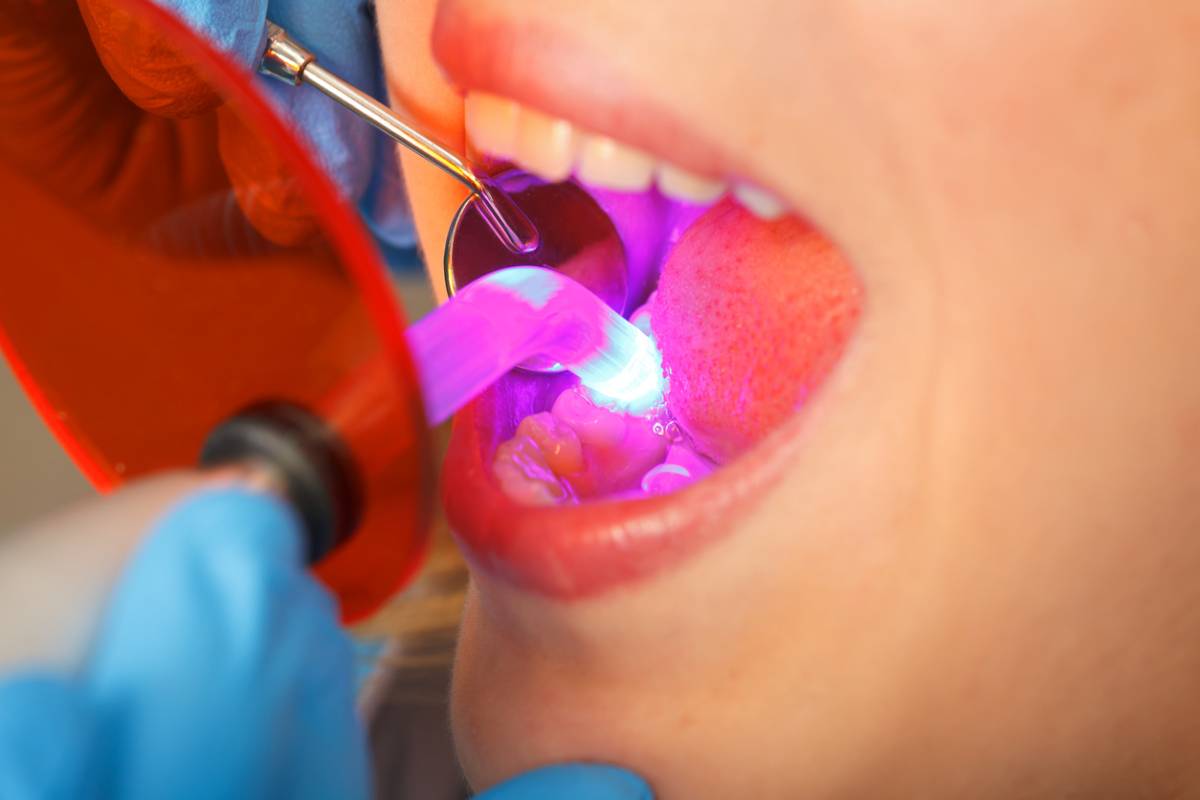 featured image for how dental bonding improves your smile aesthetic
