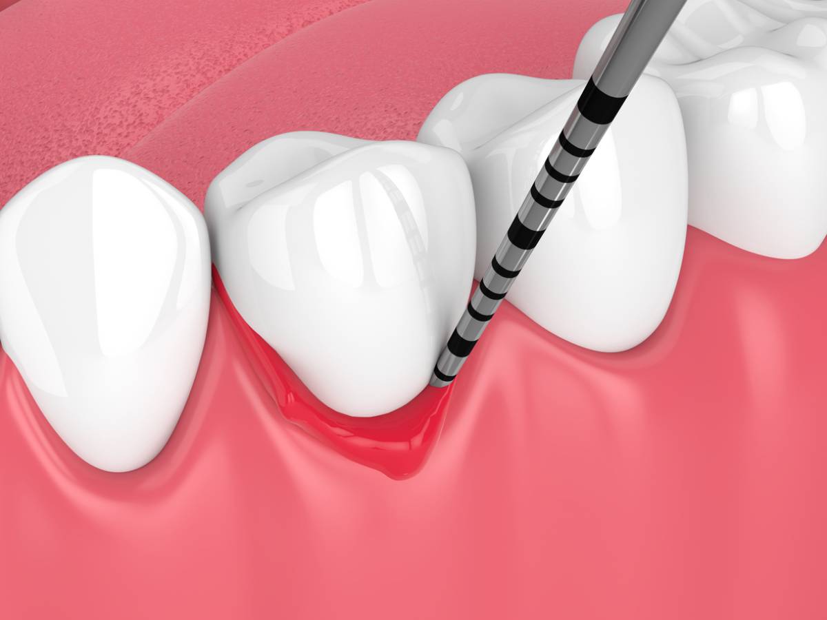 concept image of receding gums treatments