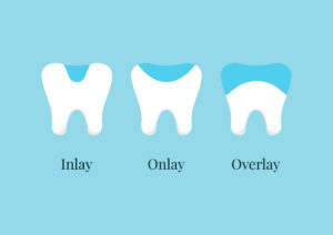 concept image for inlays and fillings