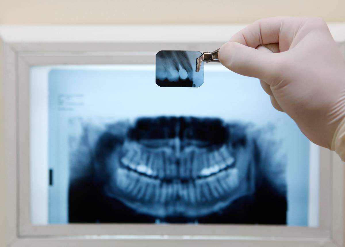 featured image for key benefits of dental x-rays