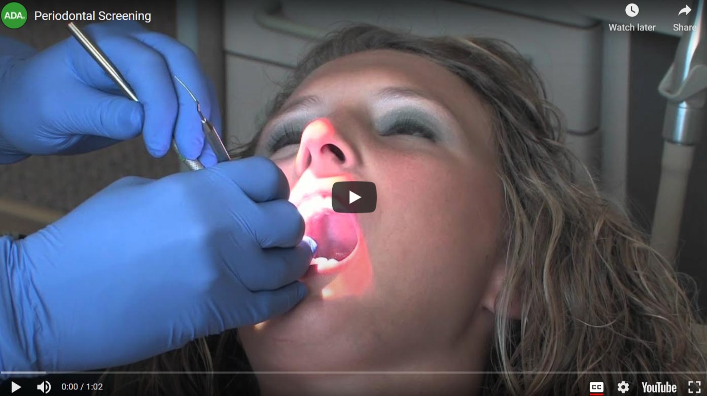 periodontal-screening-video