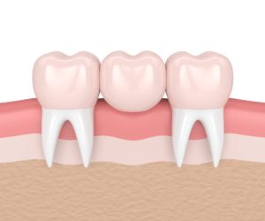 Illustration of dental bridges
